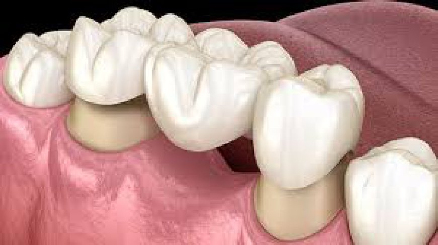 High-Quality Teeth Crowns in Dubai: Where to Find Them