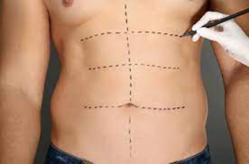 Liposuction: A Comprehensive Guide