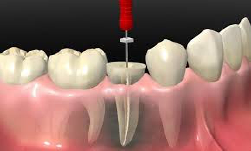 Root Canal for Broken Tooth: Restoring Functionality and Appearance