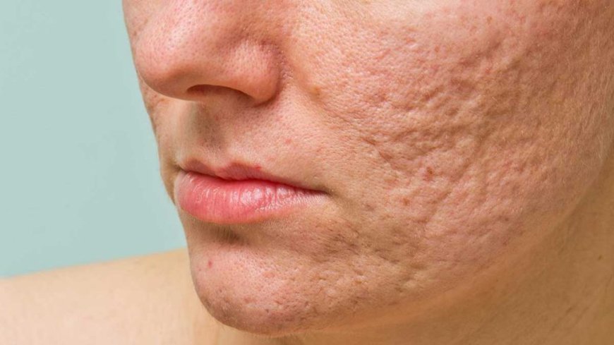 Acne Scars No More: How Laser Therapy is Changing Lives