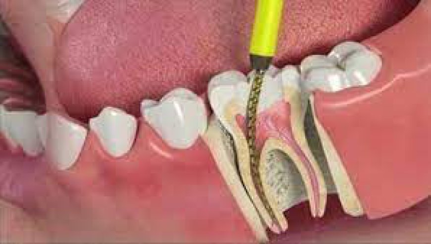 Choosing Between Root Canal and Tooth Extraction