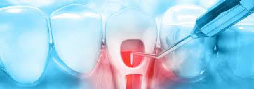 Root Canals and Overall Health: Is There a Connection?