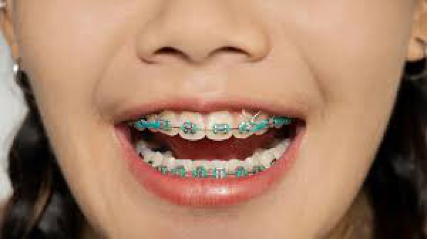 Smile Confidently with Dubai's Premier Dental Braces Clinics