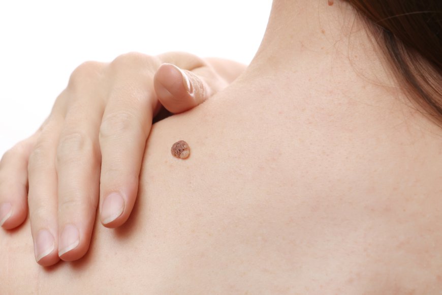 Recovery and Aftercare Tips for Skin Tag Removal in Dubai