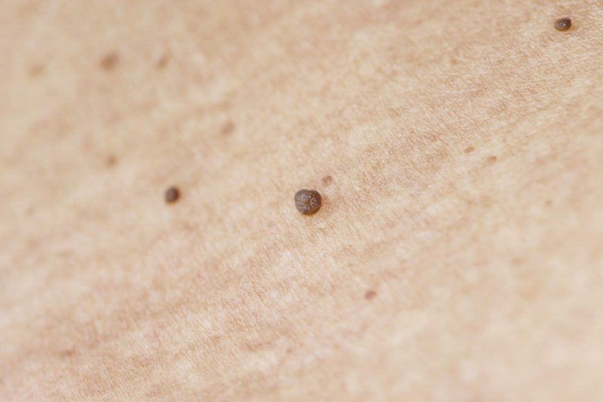 Skin Tags Got You Down? Here’s What You Can Do