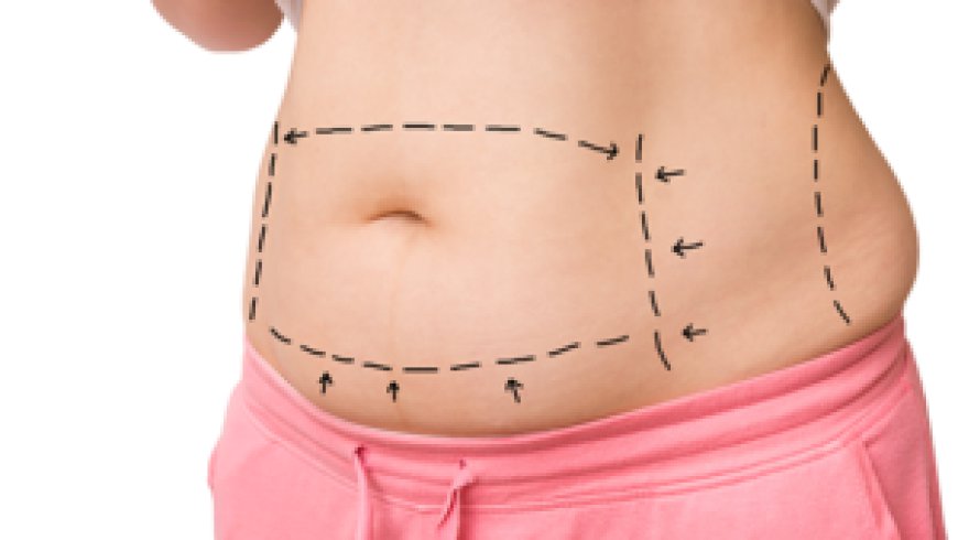 Is a Tummy Tuck in Dubai Right for You? Common Questions Answered