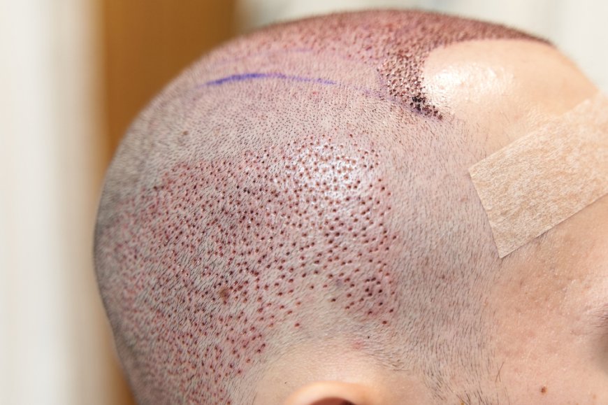 FUE Hair Transplant: Trustworthy Solutions for Hair Loss