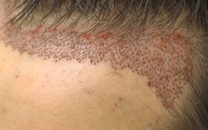 FUE Hair Transplant Dubai: The Latest Techniques for Natural Results