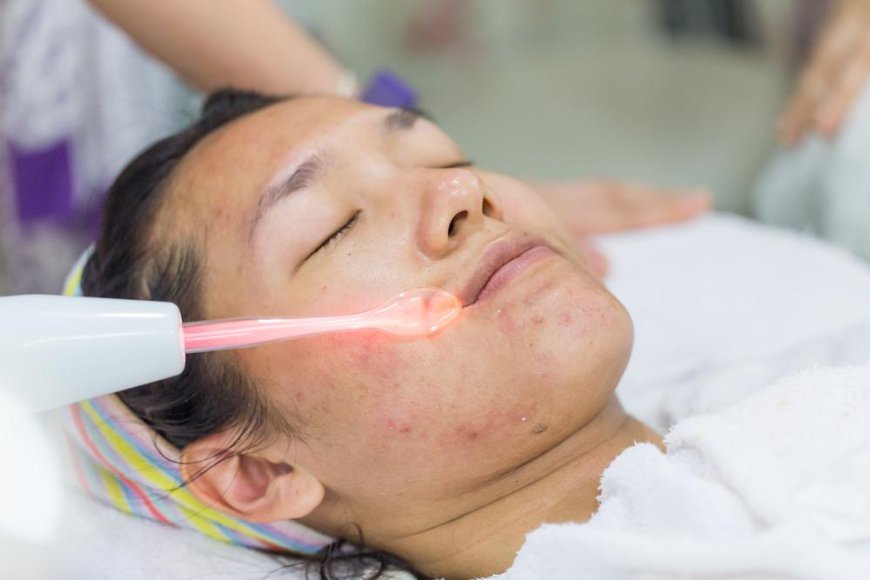 The Benefits of Choosing Laser Acne Treatment