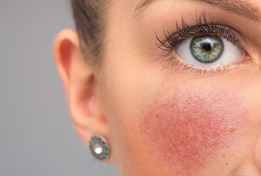 Get Smooth Skin with Rosacea Treatment