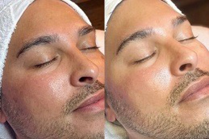 HydraFacial for Men in Dubai: Effective for All Skin Types