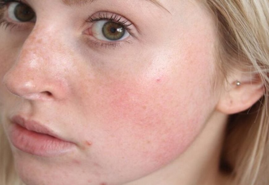 Rosacea Treatment for Radiant, Even-Toned Skin