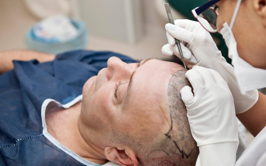 Do’s and Don’ts Before a Hair Transplant Surgery