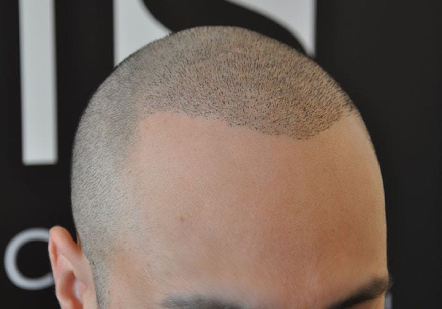 Combining Scalp Micropigmentation with Hair Restoration: What You Need to Know