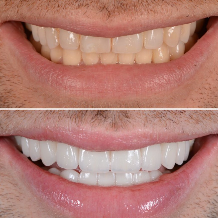 Flawless Smiles Begin with E-Max Veneers in Riyadh