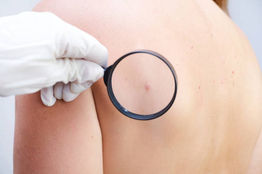 Get a Clear View of Your Skin with Dermoscopy Mole Evaluation