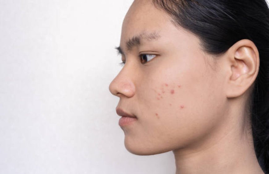 Discover How Dermoscopy Mole Evaluation Enhances Skin Health