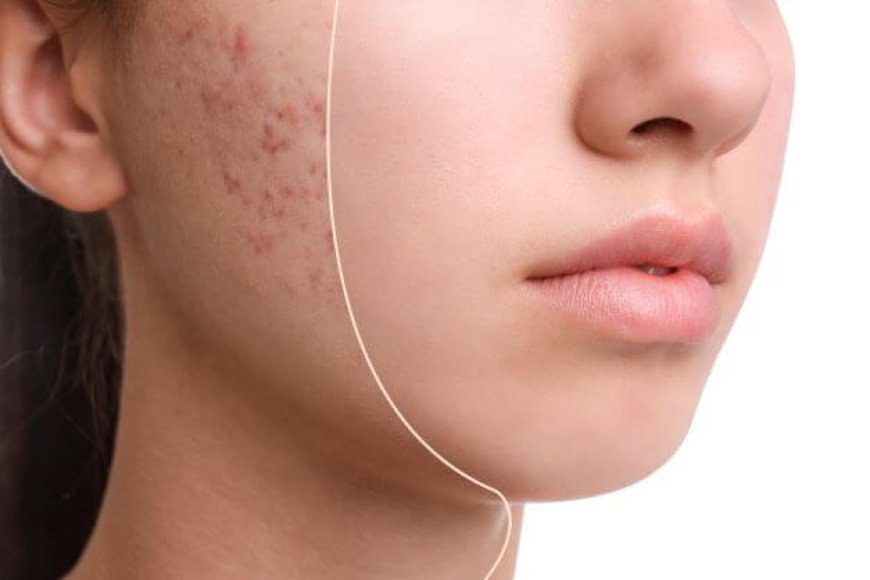 What is best for Face Acne?