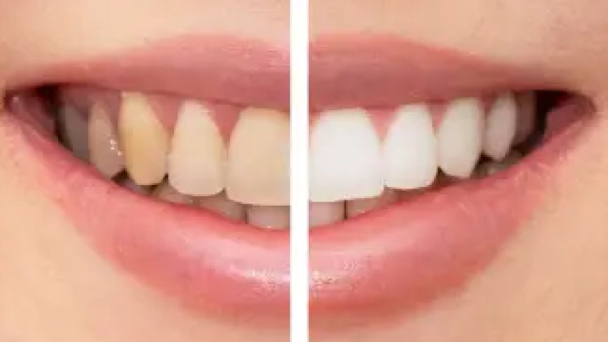 Is Teeth Whitening Safe and Effective?