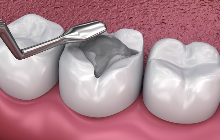 Affordable Solutions: The Real Cost of Dental Fillings in Riyadh