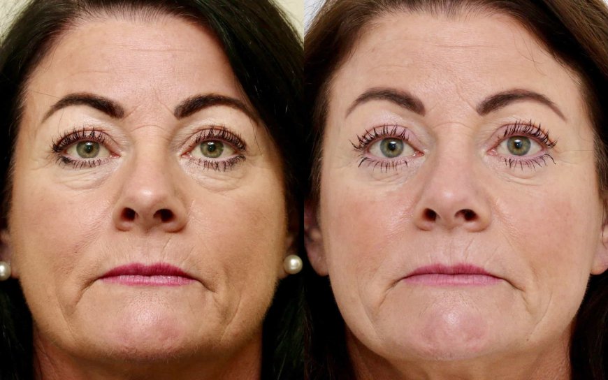 Wake Up to Youthful Eyes: Eye Bag Removal in Riyadh