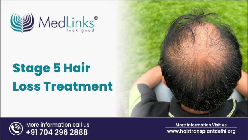 What Does Stage 5 Hair Loss Treatment Involve?