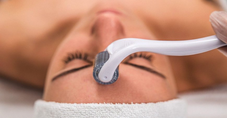 Say Farewell to Imperfections with Microneedling