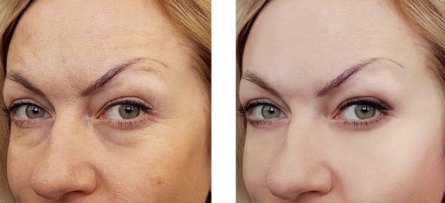 Achieve Flawless Eyes with Eyelid Surgery in Riyadh