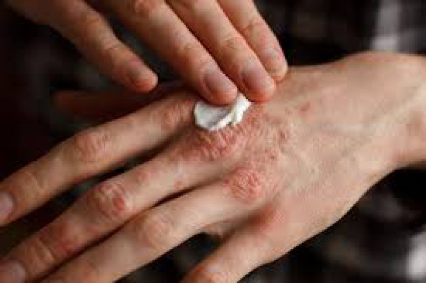 Top Psoriasis Treatment Strategies Available in Riyadh