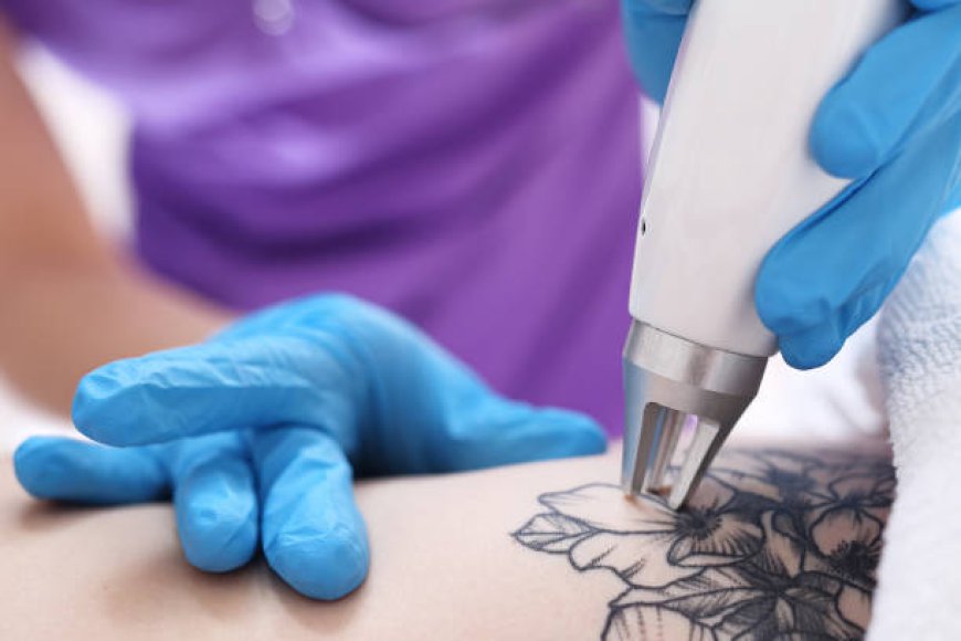 Your Complete Guide to Safe Laser Tattoo Removal in Riyadh