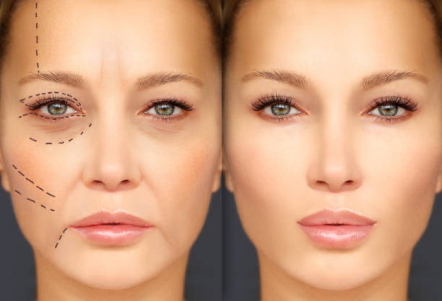 Achieve Flawless Eyes with Eyelid Surgery in Riyadh