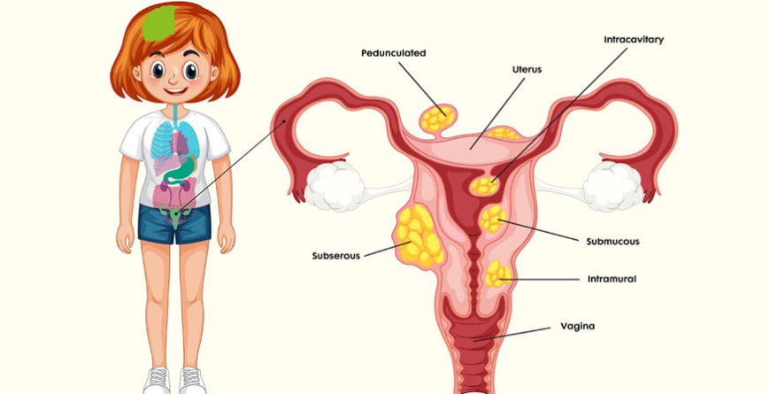 Effective Uterine Fibroids Treatment Options for Women