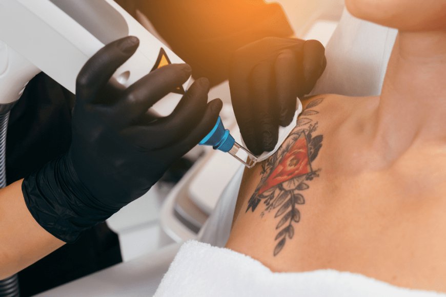 Feel Free and Confident with Laser Tattoo Removal