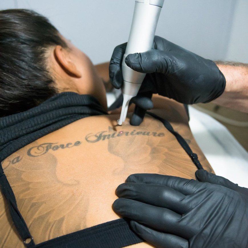 Trust the Process: Laser Tattoo Removal Simplified