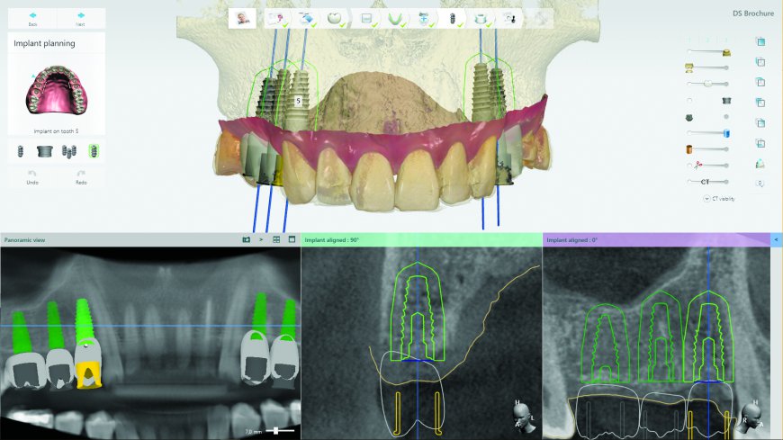 US Dental Implantation Planning Software Market Analysis, Size, Share, Growth, Trends Forecasts 2023-2030