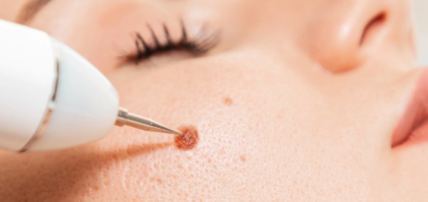 Top Skin Tag Removal Treatments: Which One is Right for You?