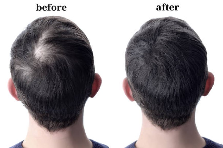 Finding the Best Hair Transplant in Jaipur for Natural Results