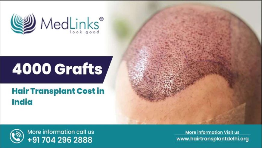 4000 Grafts Hair Transplant Cost in India 2024