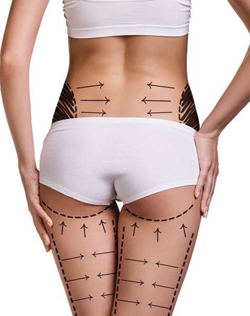 Budgeting for Liposuction in Riyadh: What Are the Costs?