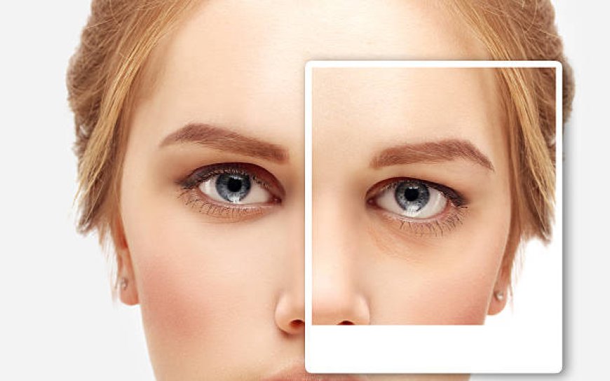 Elevate Your Appearance with the Best Eyelid Surgery Doctor in Riyadh