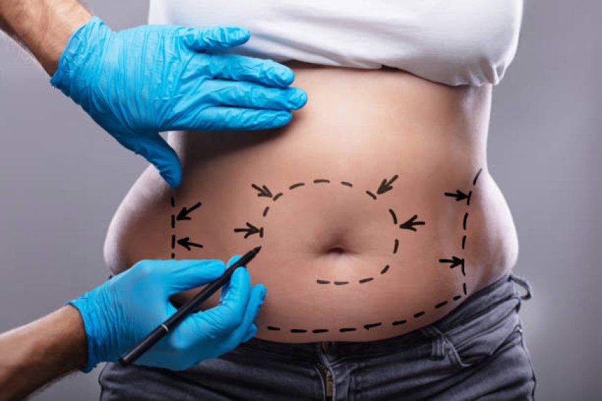 Exploring the Cost Factors: Body Liposuction Pricing Insights in Riyadh