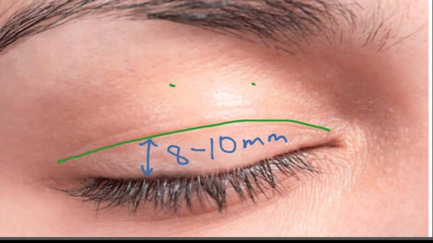 The Ultimate Checklist for Choosing the Best Eyelid Surgery Doctor in Riyadh