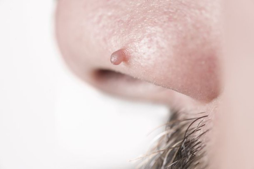 Discover the Latest Innovations in Skin Tag Removal Treatment