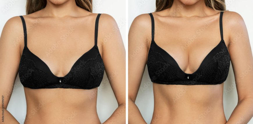 Who Needs Breast Reduction Surgery?