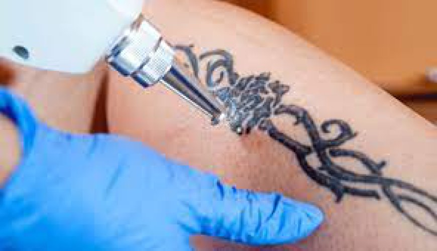 What are the Benefits of Laser Tattoo Removal?