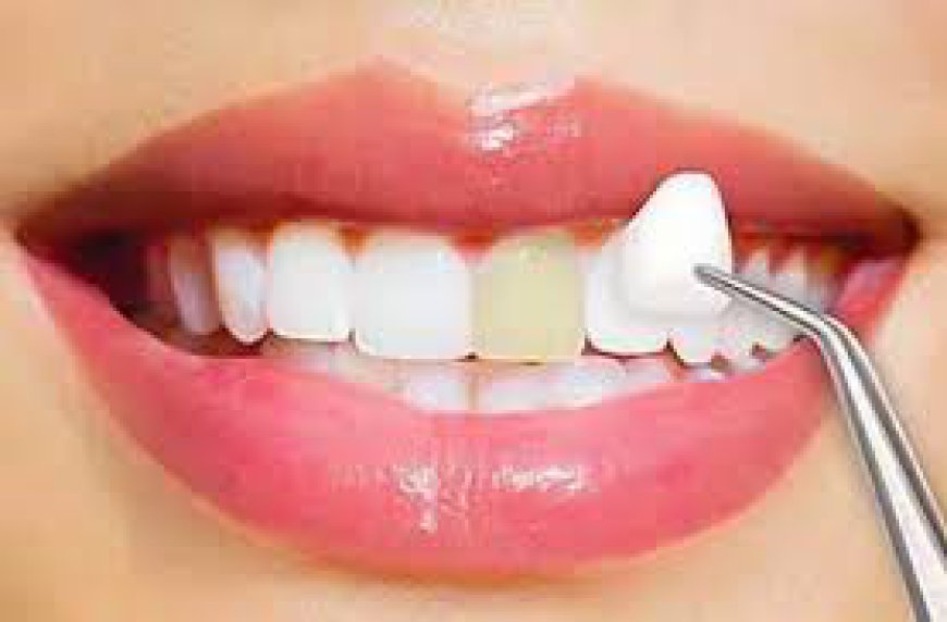 Get the Smile You Deserve with E-Max Veneers in Riyadh