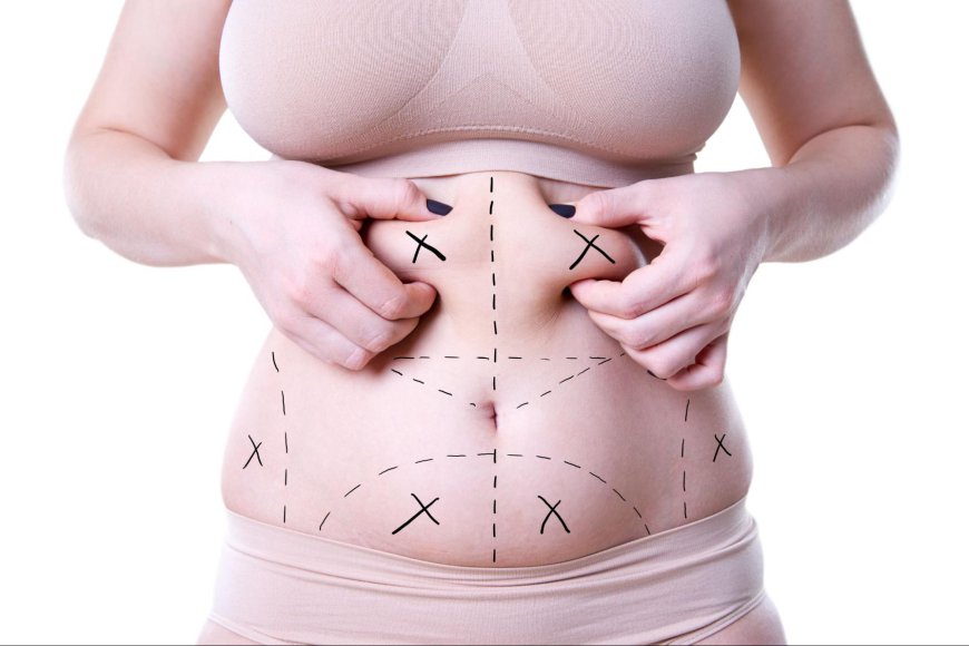 What to Expect: The Cost of Liposuction in Riyadh