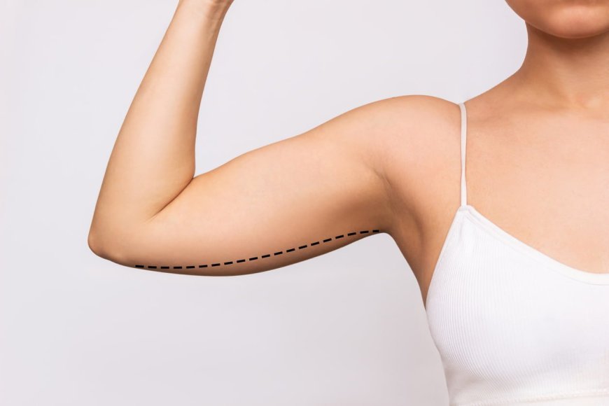 The Ultimate Guide to Arm Lift Surgery: What You Need to Know