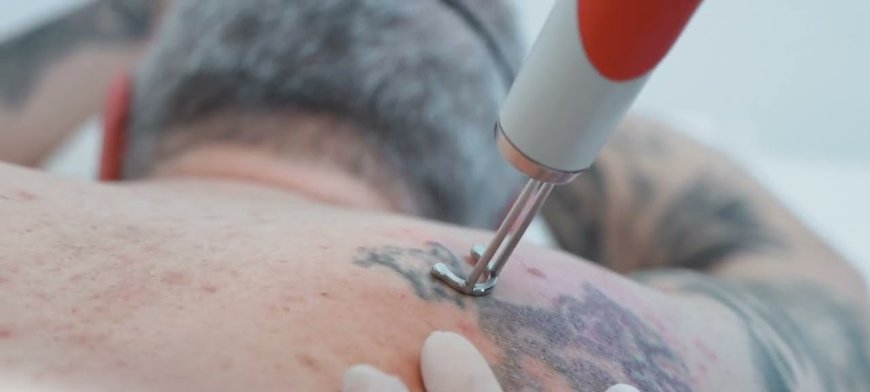 Laser Tattoo Removal: Love Your Skin Again