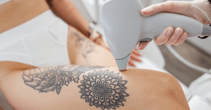 Clear Your Mind and Skin with Laser Tattoo Removal